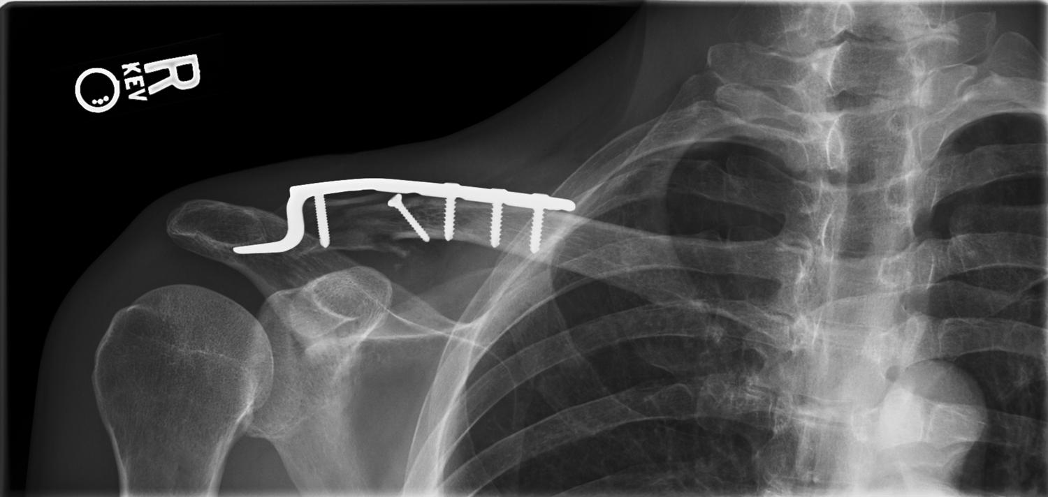 Distal Third Clavicle Fractures Trauma Orthobullets